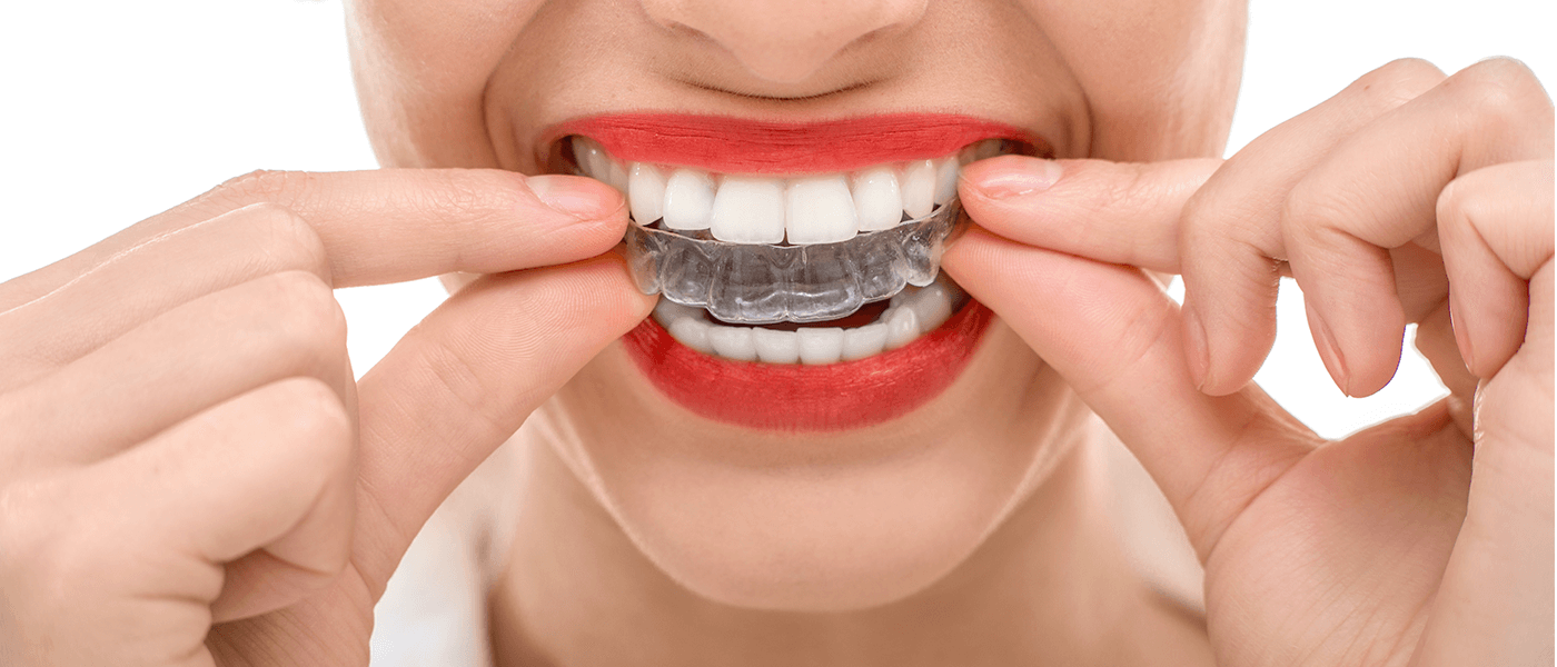 Home whitening treatment